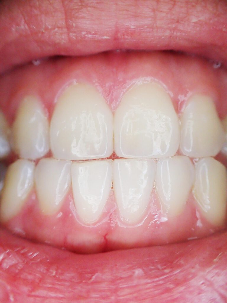 teeth, mouth, dental, dentist, tooth, lips, oral, gum, lip, red teeth, red lips, teeth, teeth, teeth, teeth, teeth, tooth